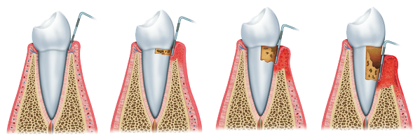 Periodoncia